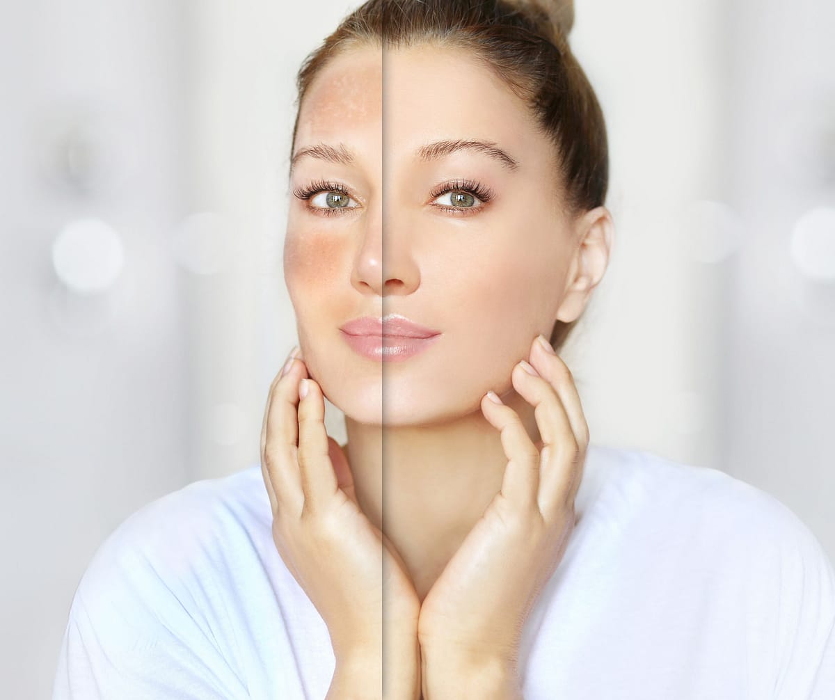 Imagen de antes y después que muestra la efectividad de la crema despigmentante para reducir la apariencia de manchas solares y mejorar el tono de la piel.